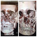 xrays-before and after